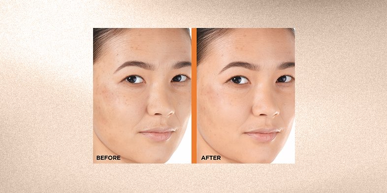Model applying Bright Reveal Dark Spot Peel to highlight solutions for how to remove sun spots and achieve even complexion.